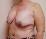 Patient # 37349 Before Photo # 1